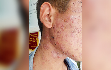 囊肿型痤疮 &middot; 修复中