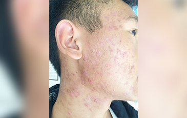 囊肿型痤疮 &middot; 修复后