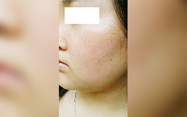 扁平疣 &middot; 修复后