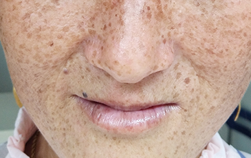 色素斑 &middot; 修复前