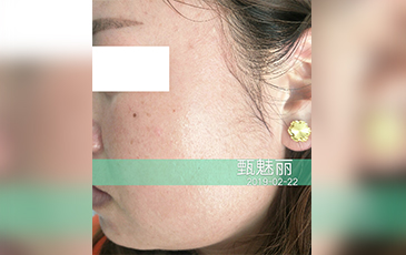 激素脸 &middot; 修复后