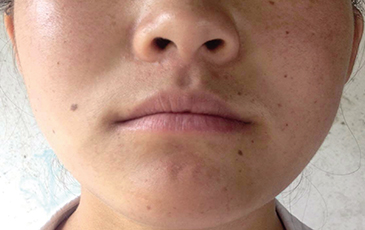 口周皮炎 &middot; 修复后