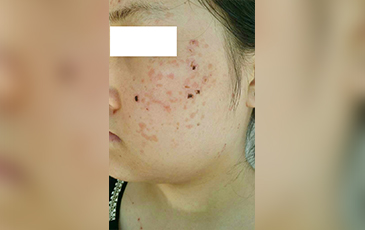 扁平疣 &middot; 修复前