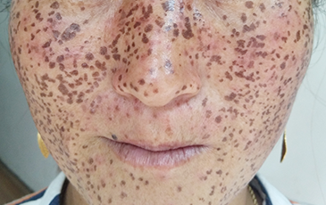 色素斑 &middot; 修复中