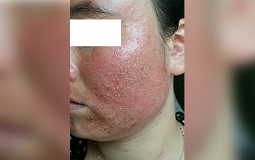 激素脸 &middot; 修复前