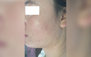 激素脸 &middot; 修复中