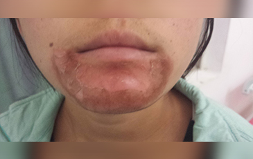 口周皮炎 &middot; 修复前