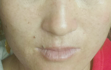 色素斑 &middot; 修复后