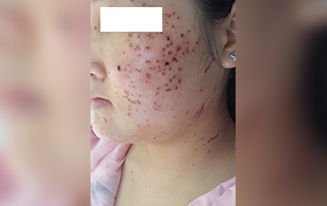 扁平疣 &middot; 修复中