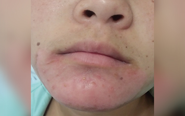 口周皮炎 &middot; 修复中