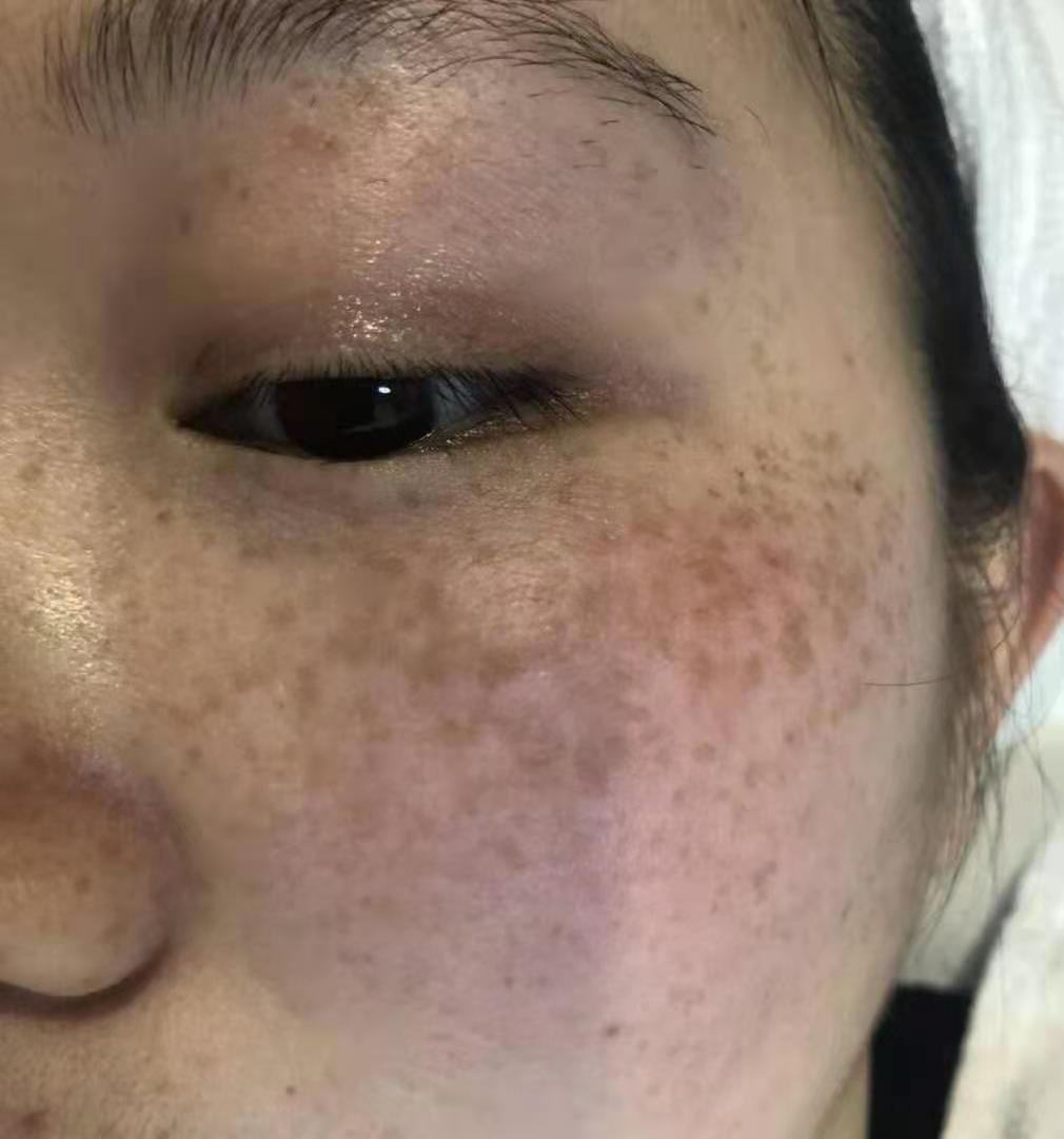 真皮斑修复 &middot; 修复前