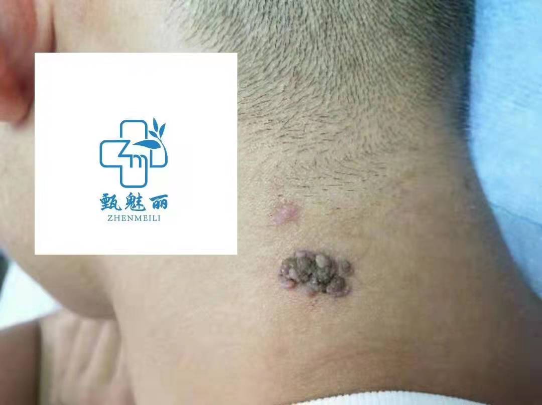 病毒疣修复 &middot; 修复前