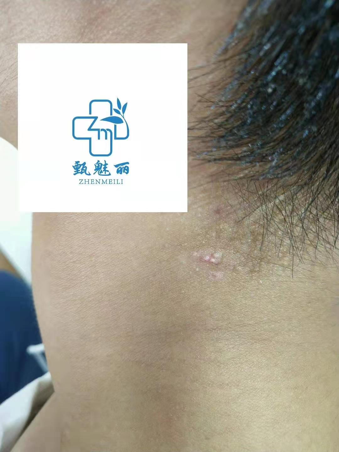 病毒疣修复 &middot; 修复后