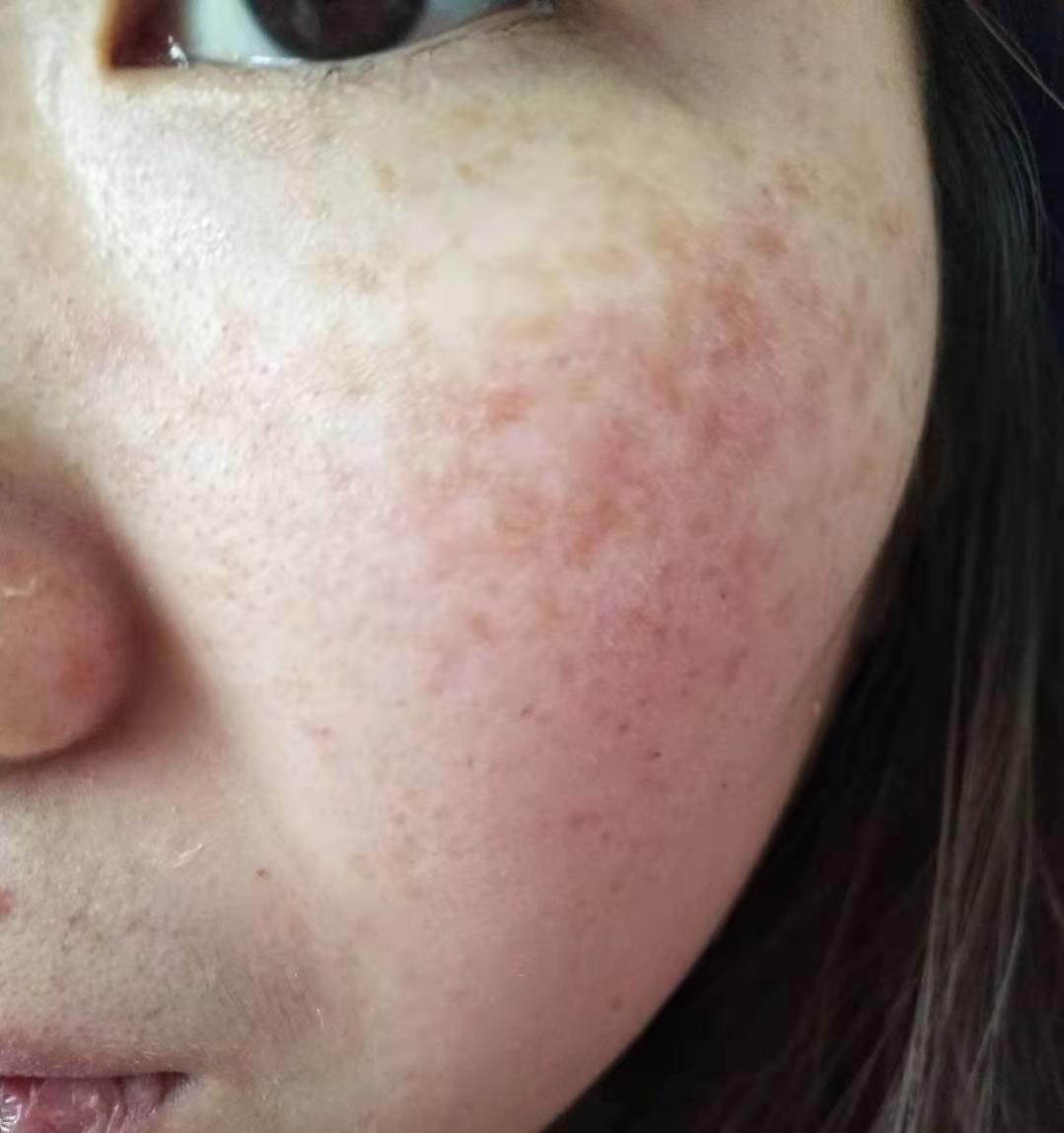 真皮斑修复 &middot; 修复中