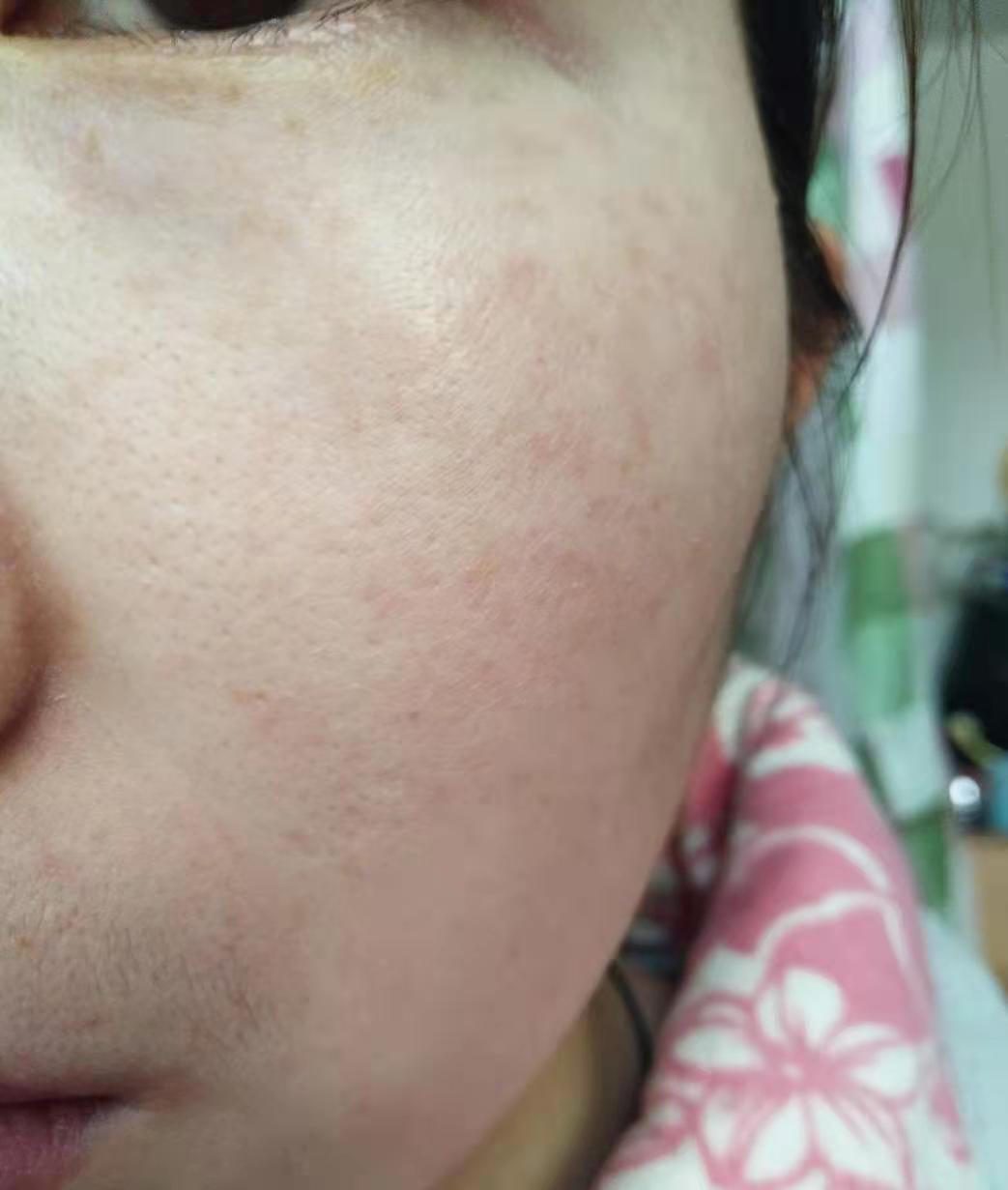 真皮斑修复 &middot; 修复后